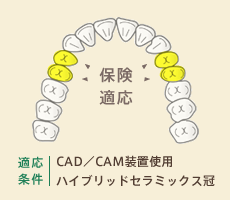 保険適応条件：CAD／CAM装置使用ハイブリッドセラミックス冠
