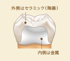 外側はセラミック（陶器）、内側は金属